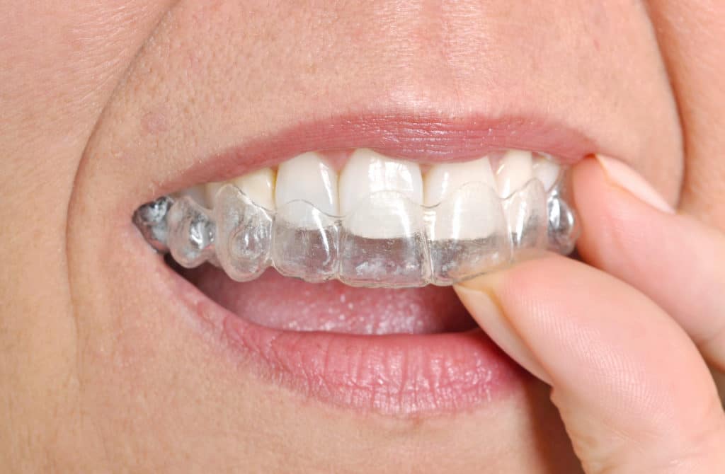 Conseils pour le port des gouttières orthodontiques
