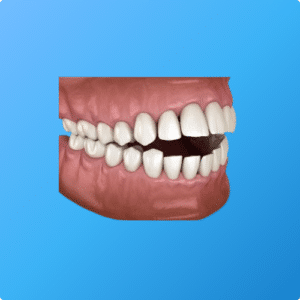 Béance dentaire