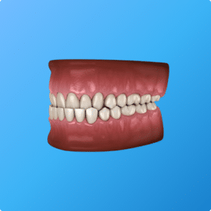 Classe III dentaire