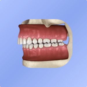 Classe II dentaire