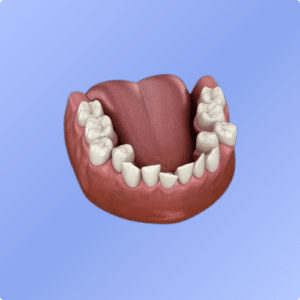 Encombrement dentaire