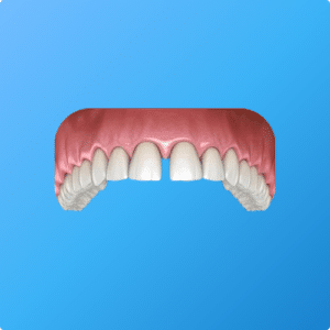 Espacements dentaires