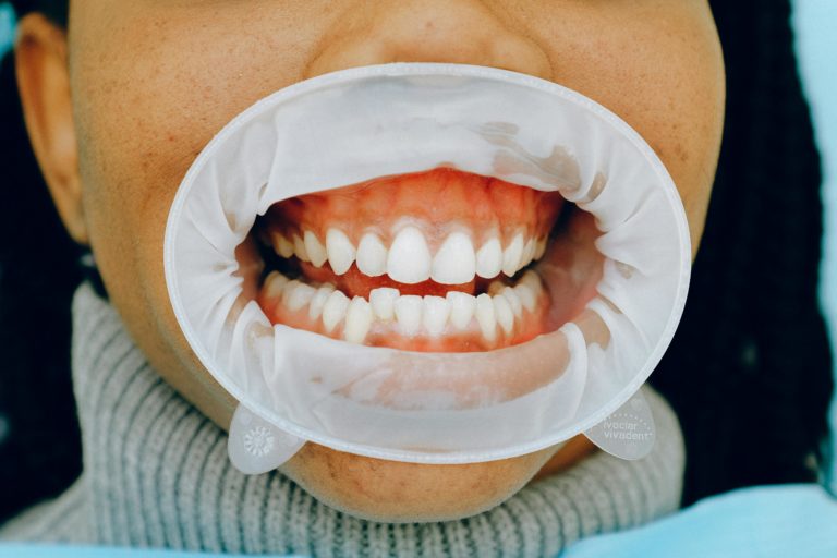 Aligner les Dents Naturellement Méthodes et Prix de l