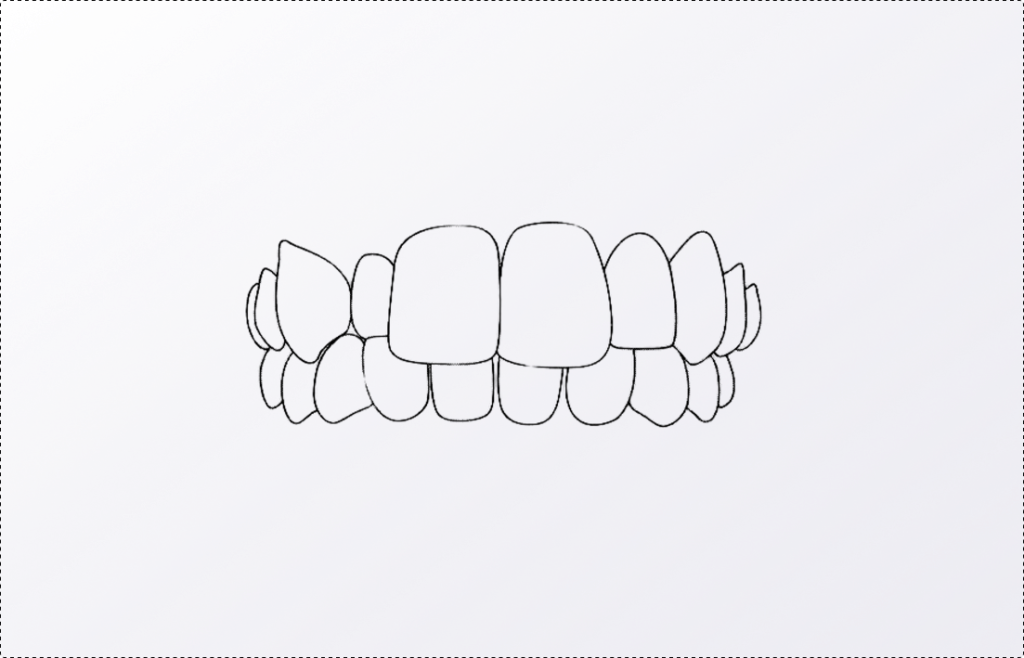 Sourire _ articulé d'inversé