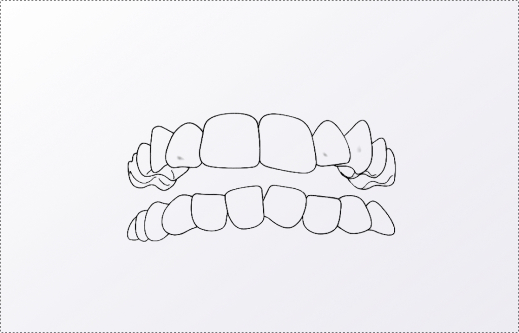 Sourire _ chevauchement dentaire