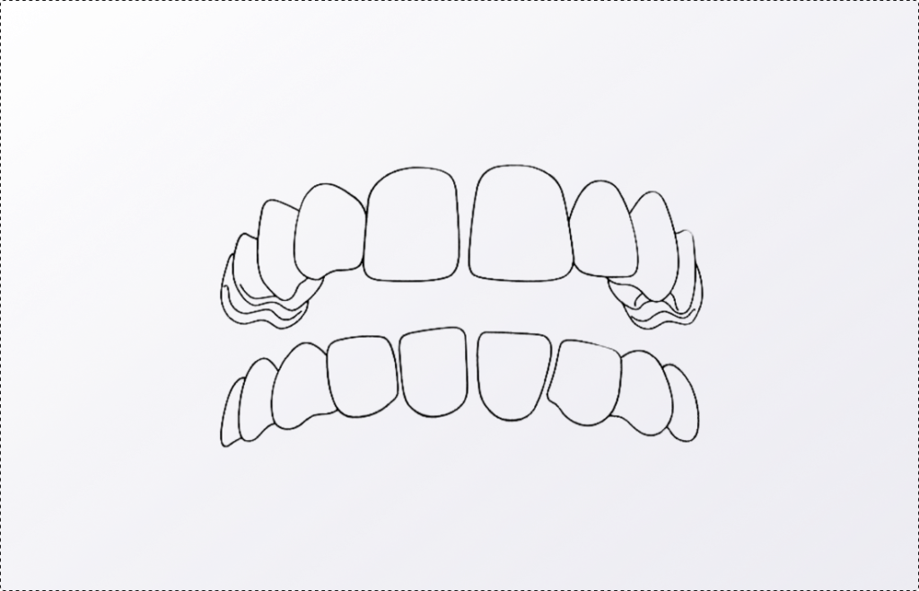Sourire _ espacement dentaire