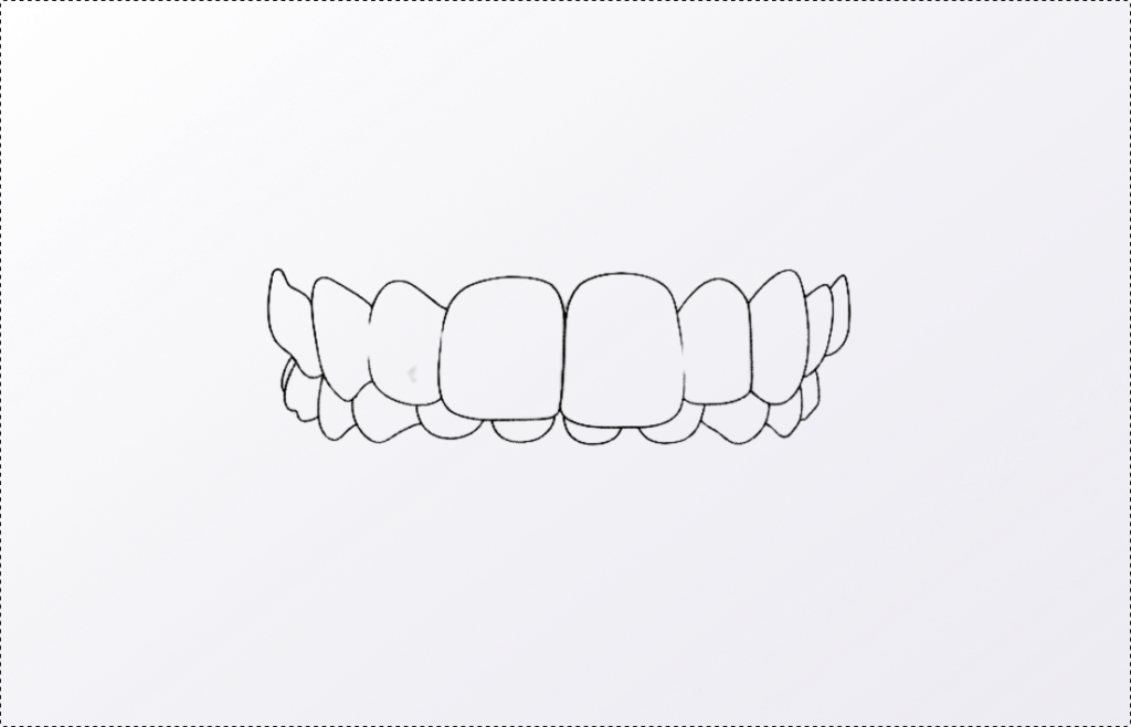Sourire _ supraclusion