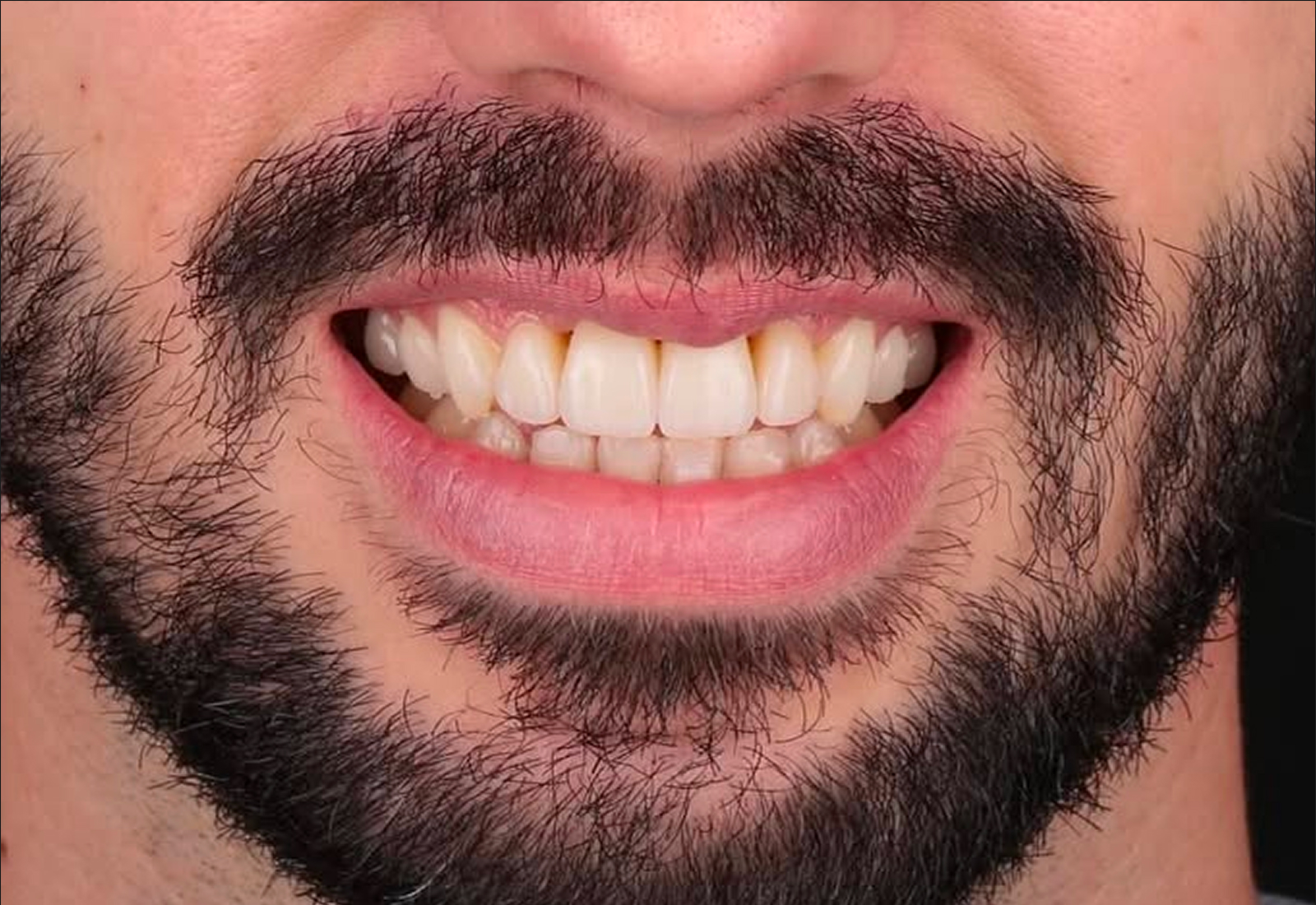 sourire après aligneurs invisibles : découvrez le résultat obtenu en quelques mois