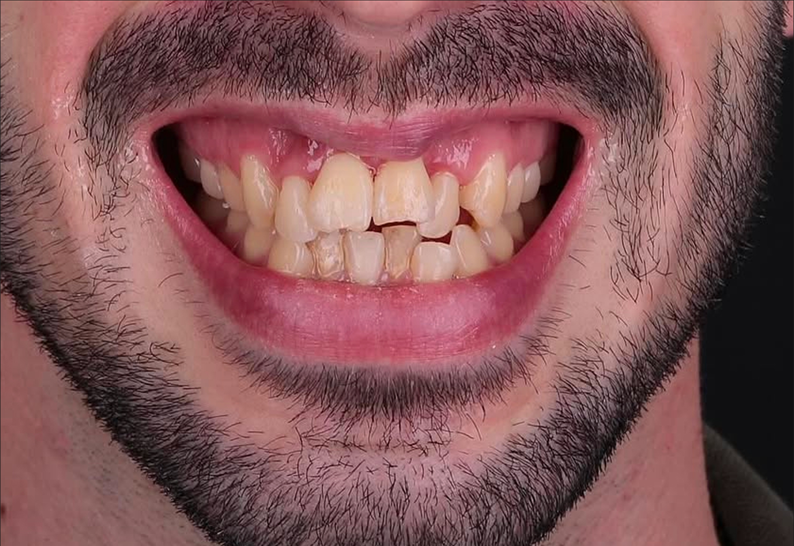 sourire avant aligneurs invisibles : découvrez le résultat obtenu en quelques mois
