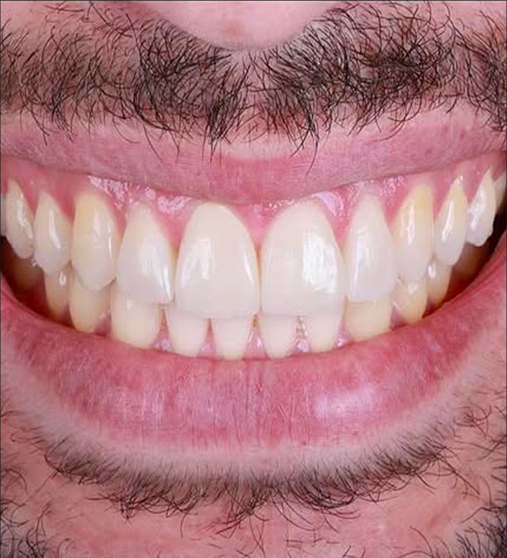sourire après aligneurs invisibles : découvrez le résultat obtenu en quelques mois