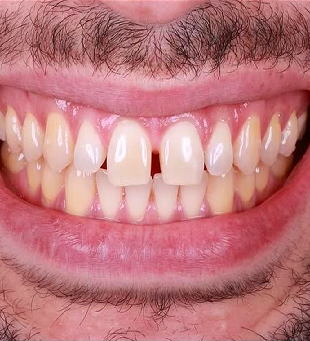 sourire avant aligneurs invisibles : découvrez le résultat obtenu en quelques mois