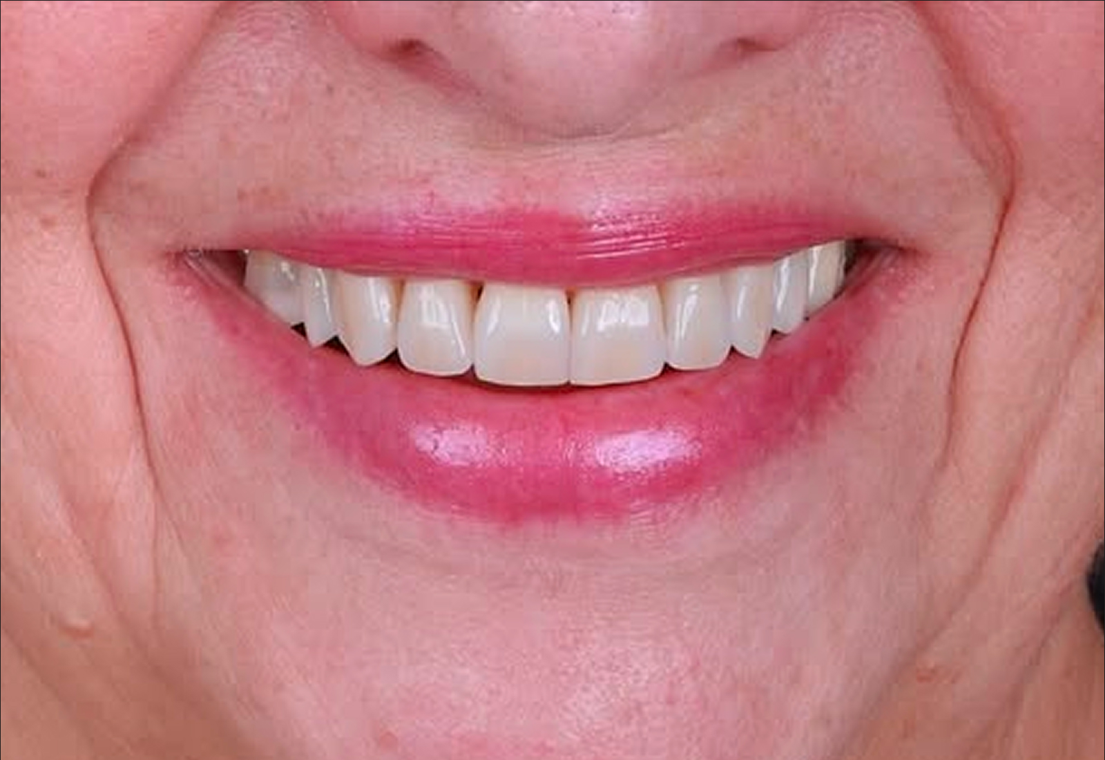 sourire après aligneurs invisibles : découvrez le résultat obtenu en quelques mois