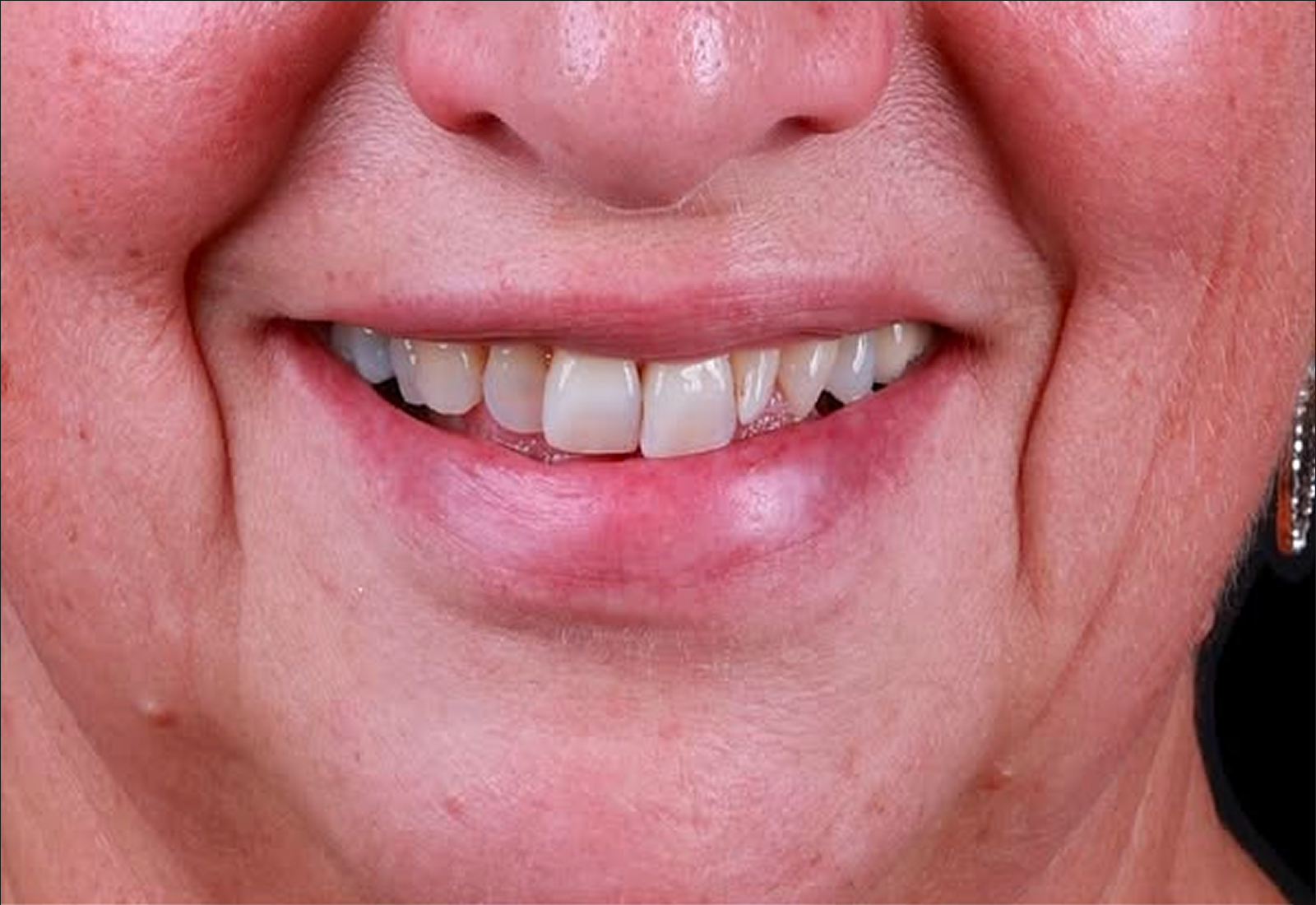 sourire avant aligneurs invisibles : découvrez le résultat obtenu en quelques mois