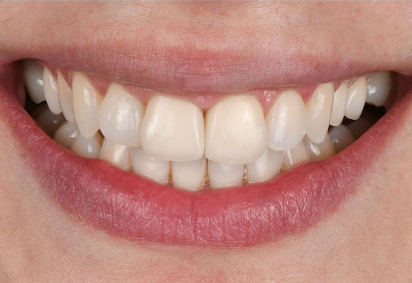 sourire après aligneurs invisibles : découvrez le résultat obtenu en quelques mois