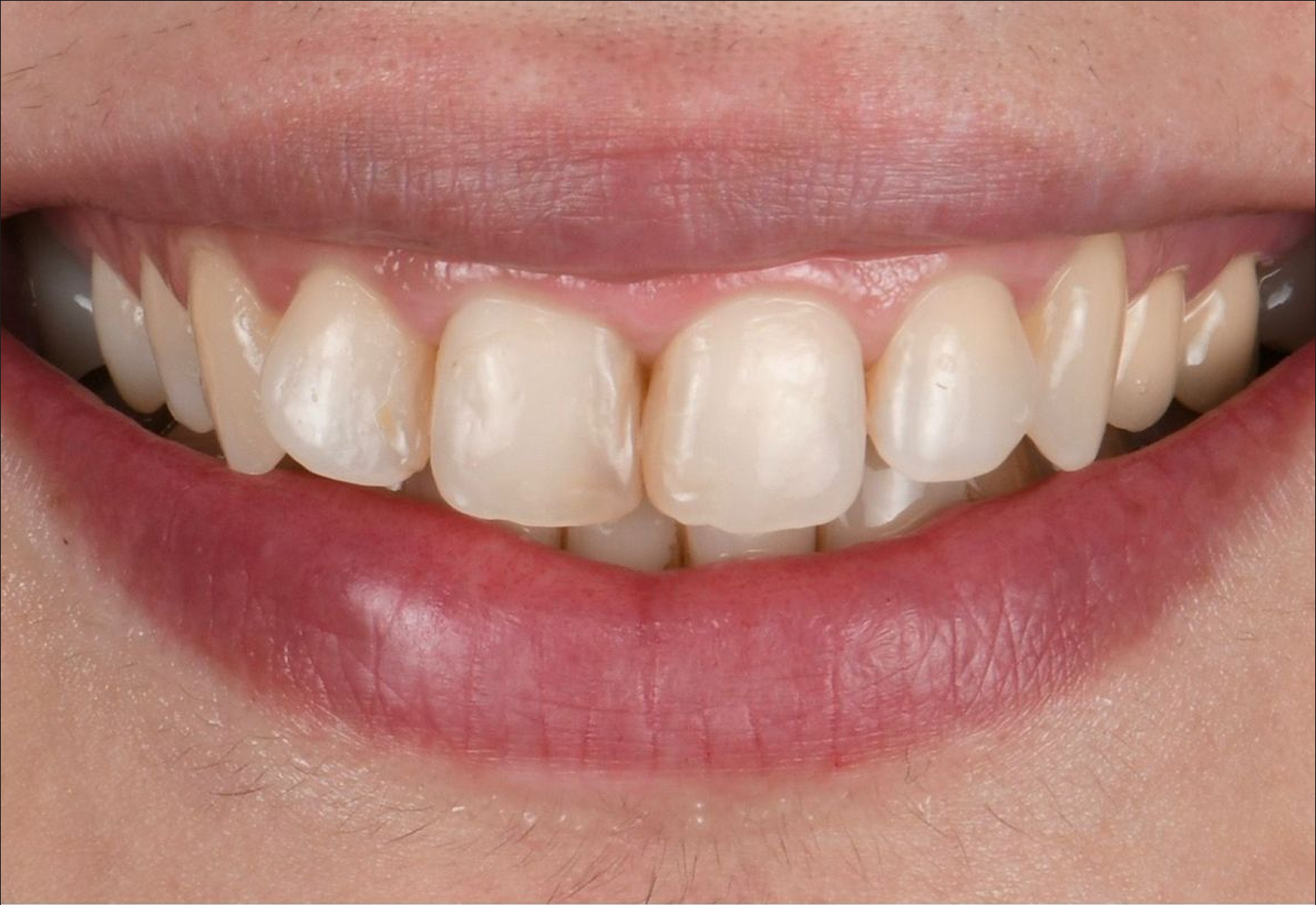 sourire avant aligneurs invisibles : découvrez le résultat obtenu en quelques mois